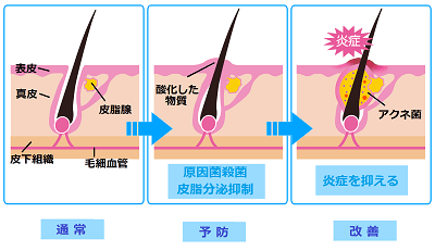 ニキビ発生のメカニズムのイラスト