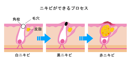 ニキビができるプロセスのイラスト
