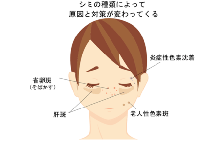 シミの種類のイラスト