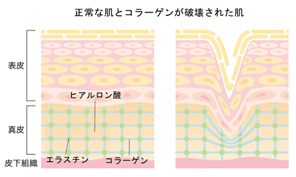 しわ、たるみの肌のイラスト