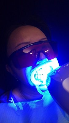 CHOICE霧島本店のセルフホワイトニング施術中の写真